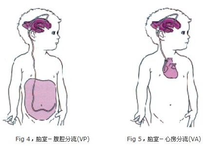 脑积水_神经内科