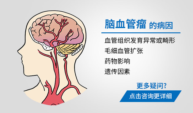 引发脑血管瘤原因有哪些