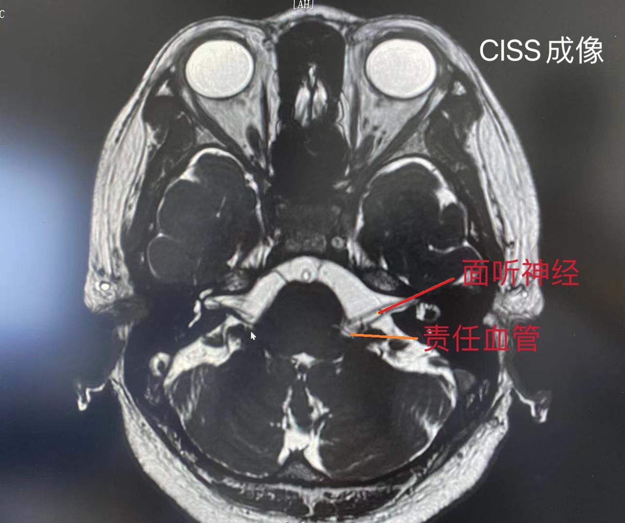 华安脑科医院成功开展首例面肌痉挛显微血管减压术